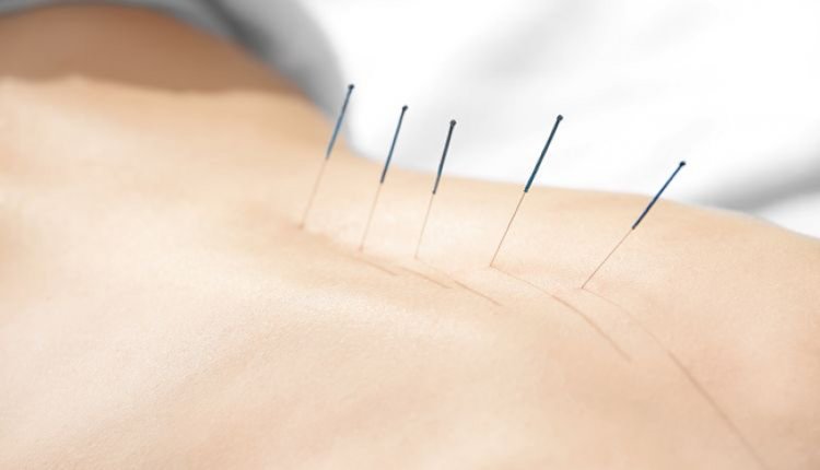 Akupunktur Tedavisi Nedir